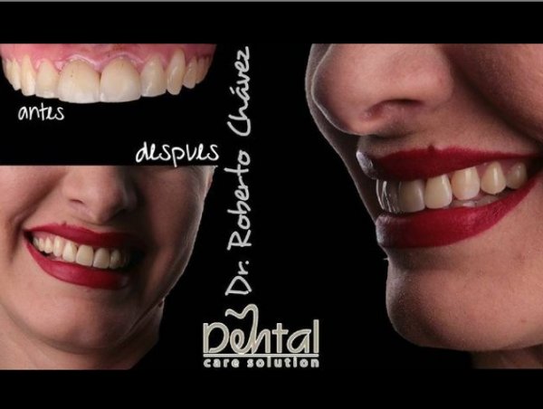 Carillas Dentales